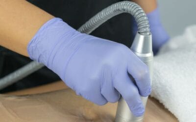 Tratamiento HIFU en Clínica Cibeles, Huelva