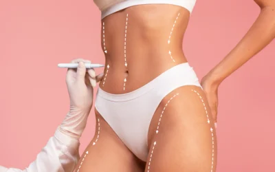 Carboxiterapia corporal: remodela tu figura sin cirugía